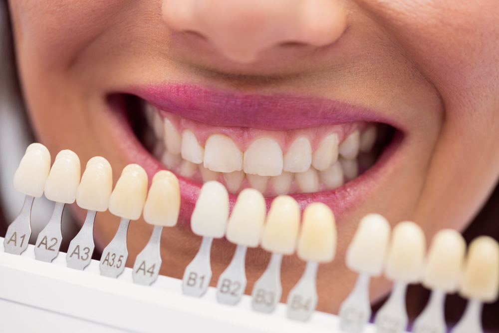 Sbiancamento dentale professionale presso lo studio Muller di Genova