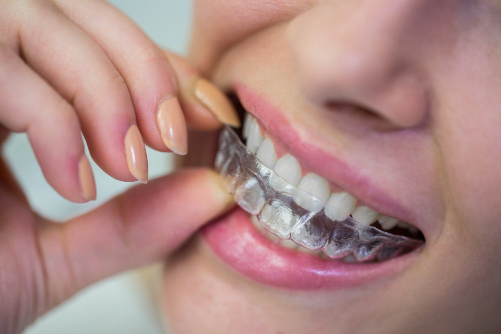 Applicazione di apparecchi invisibili Invisalign presso lo studio Muller di Genova